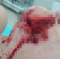 Бойцовый пес напал на 11-летнюю девочку в Челнах - Бугульминская газета